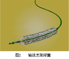 自膨式医用支架径向力学性能的测试技术
